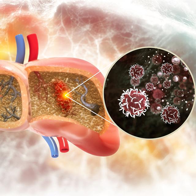liver cancer diagram