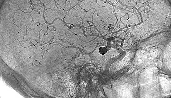 x-ray of arteries in a brain