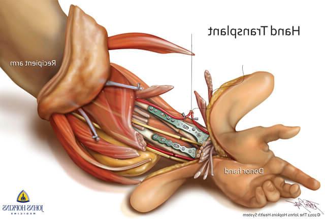 hand transplant illustration