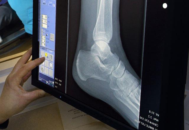 x-ray of ankle